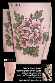 peony cover-up of hyperpigmentation scars