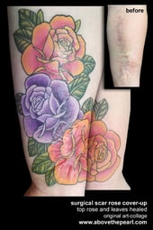 surgical scar rose cover up